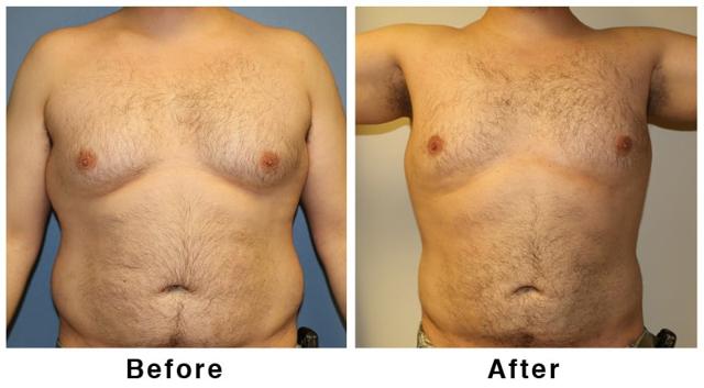 Brazilian Butt Lift result at Webb Plastic Surgery in Paradise Valley, AZ
