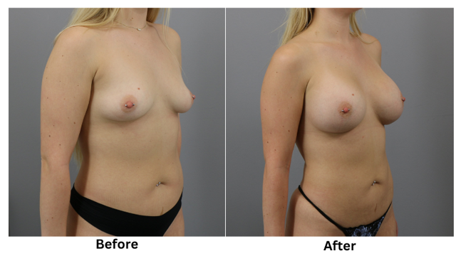 Breast Augmentation result at Webb Plastic Surgery in Paradise Valley, AZ