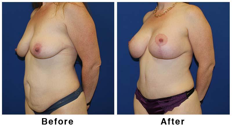 Webb Plastic Surgery breast lift result — Paradise Valley, AZ