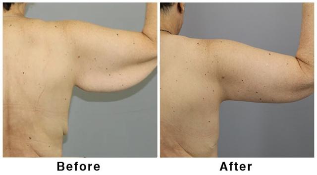 Arm Lift result at Webb Plastic Surgery in Paradise Valley, AZ