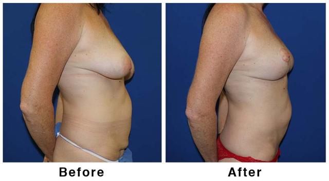 Breast Lift result at Webb Plastic Surgery in Paradise Valley, AZ