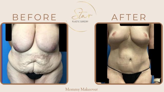 Mommy Makeover result at Star Plastic Surgery in Novi, MI