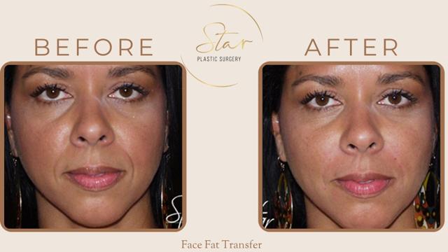 Fat Transfer result at Star Plastic Surgery in Novi, MI