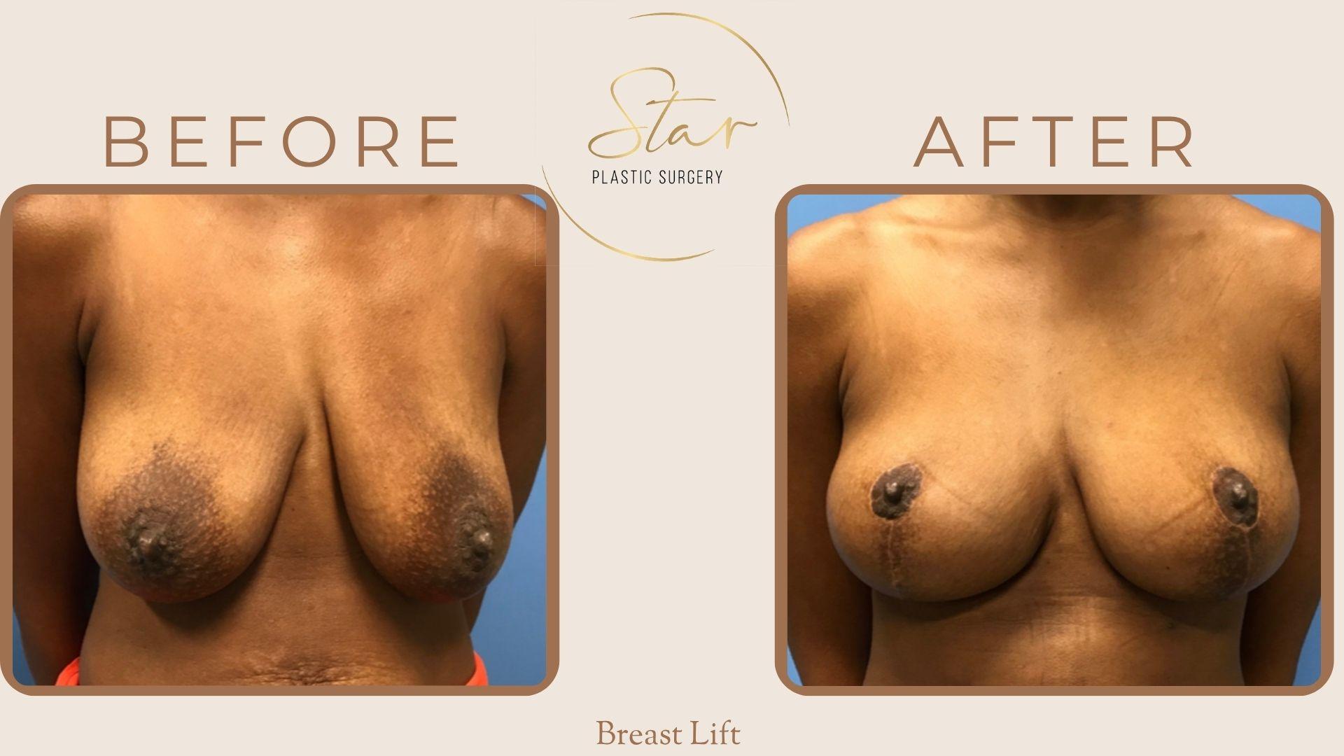 Star Plastic Surgery breast lift result — Novi, MI