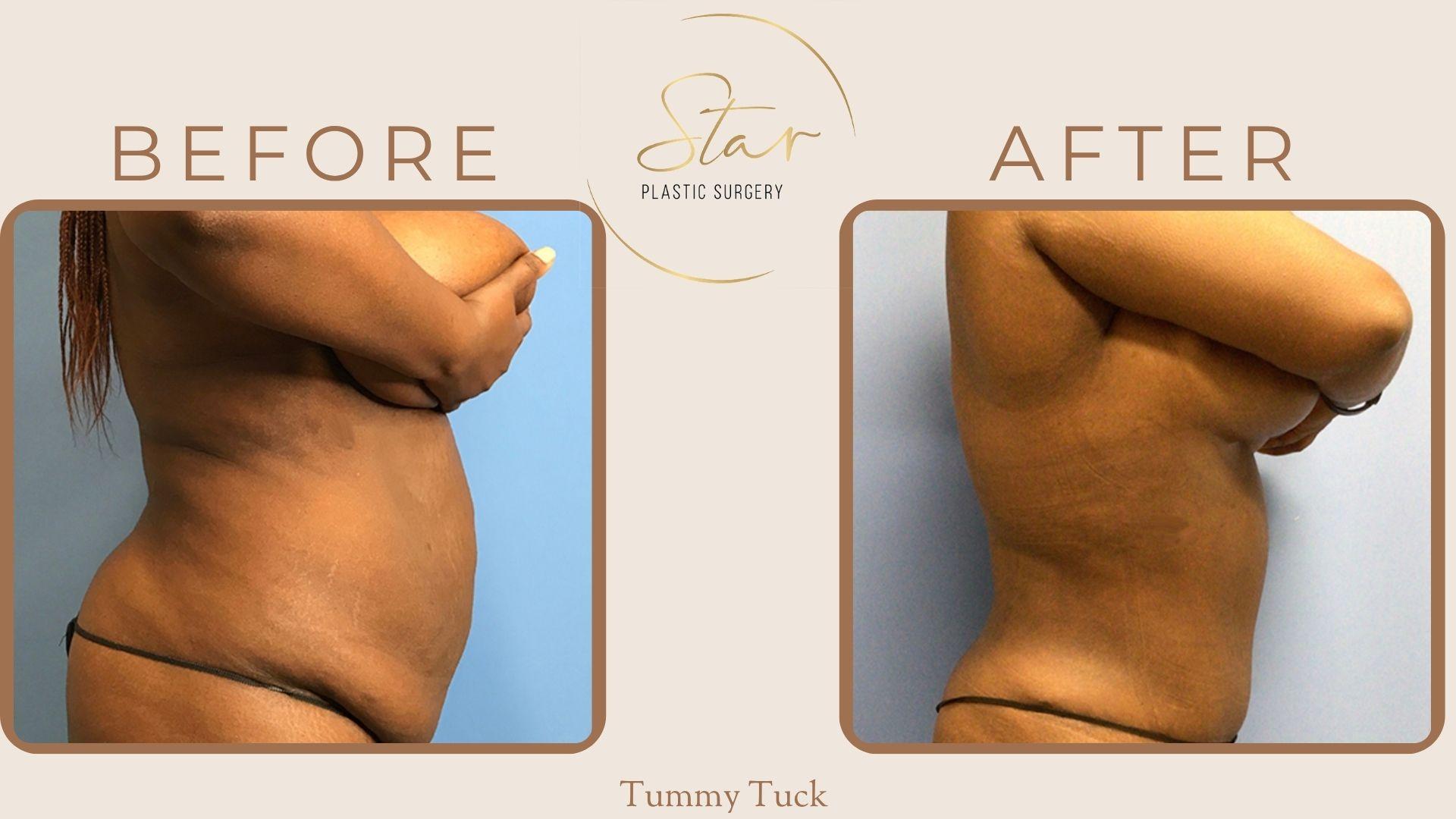 Star Plastic Surgery tummy tuck result — Novi, MI