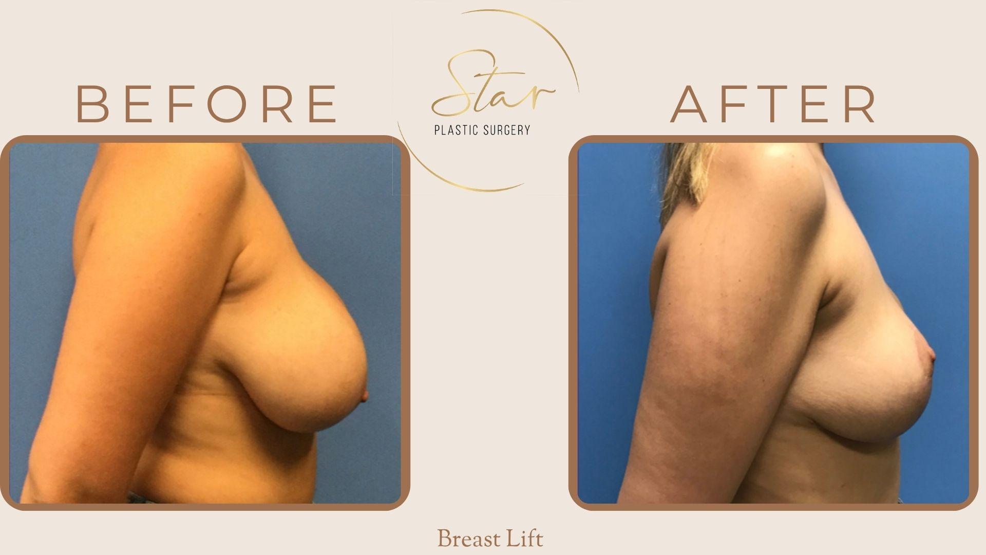 Star Plastic Surgery breast lift result — Novi, MI