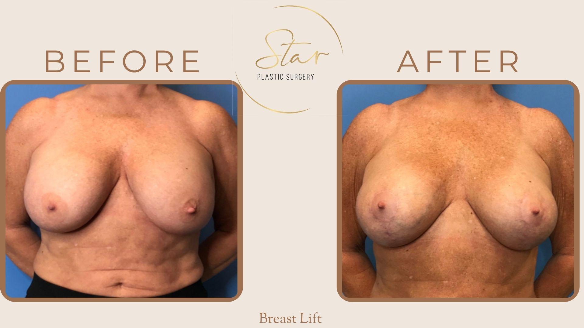 Star Plastic Surgery breast lift result — Novi, MI