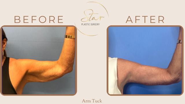 Arm Lift result at Star Plastic Surgery in Novi, MI