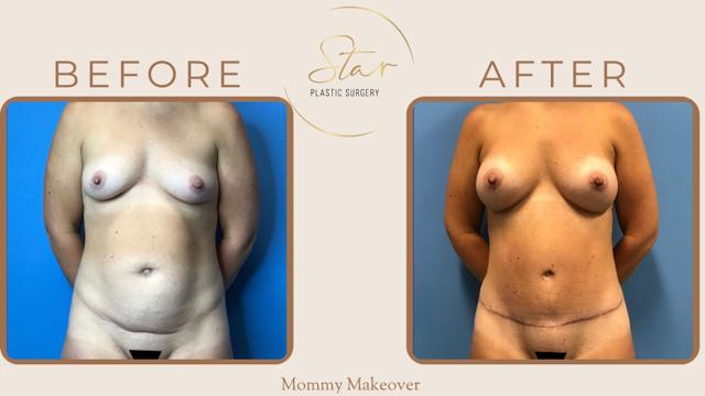 Mommy Makeover result at Star Plastic Surgery in Novi, MI