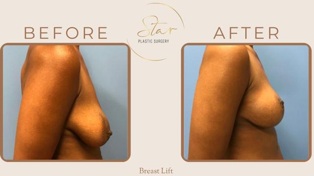 Breast Lift result at Star Plastic Surgery in Novi, MI