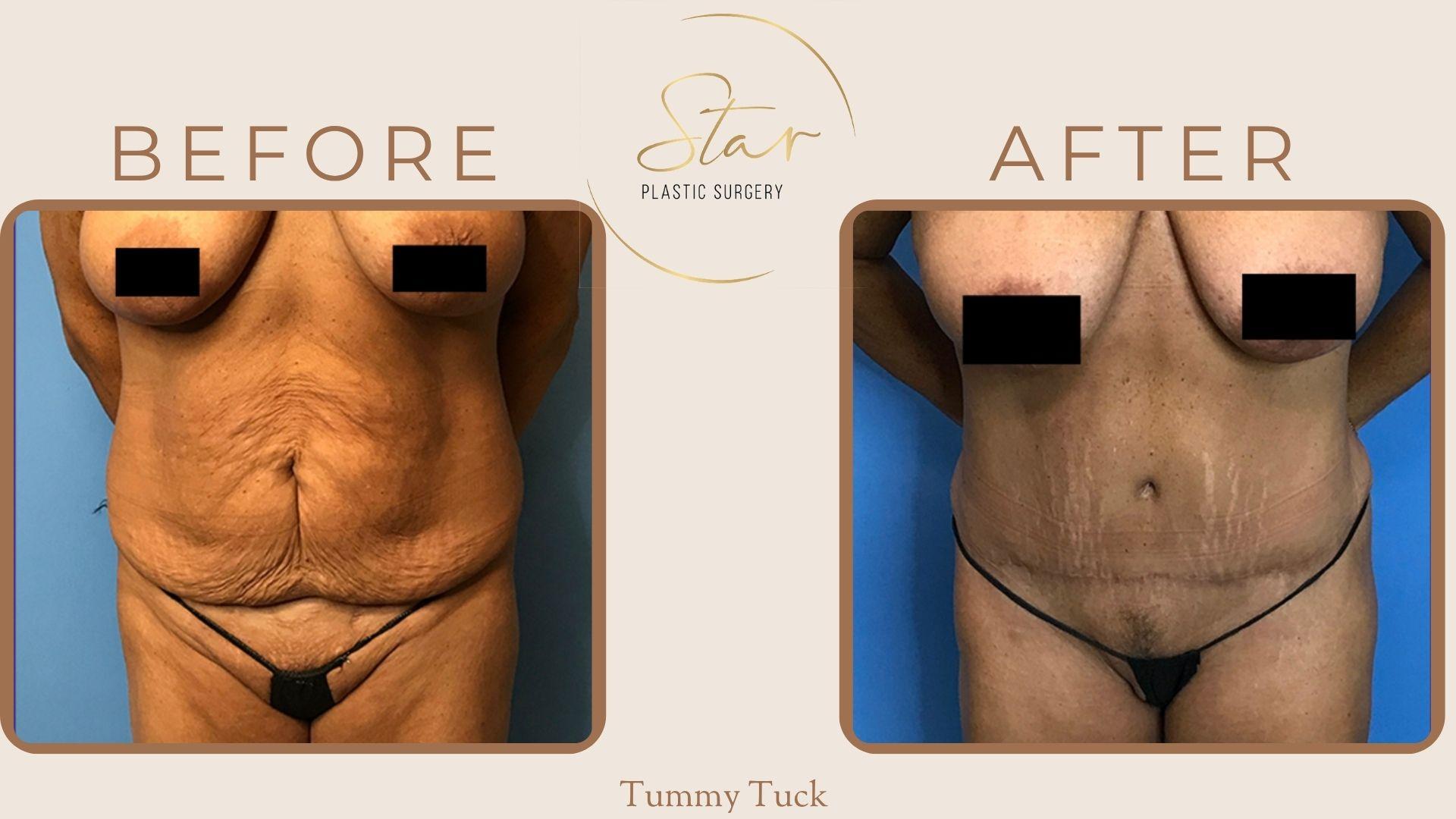 Star Plastic Surgery tummy tuck result — Novi, MI