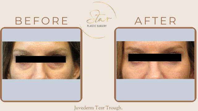 Dermal Fillers result at Star Plastic Surgery in Novi, MI
