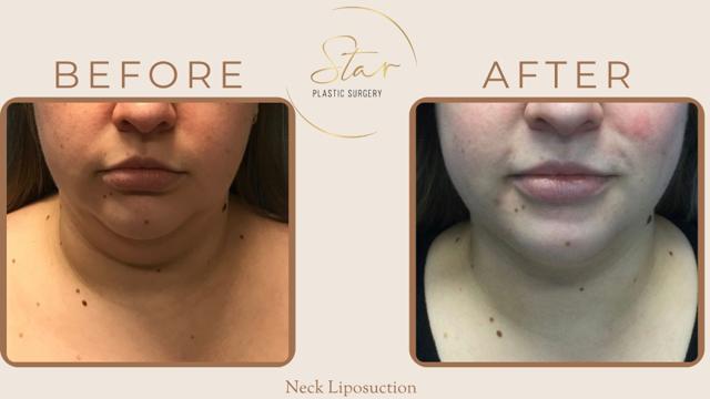 Liposuction result at Star Plastic Surgery in Novi, MI