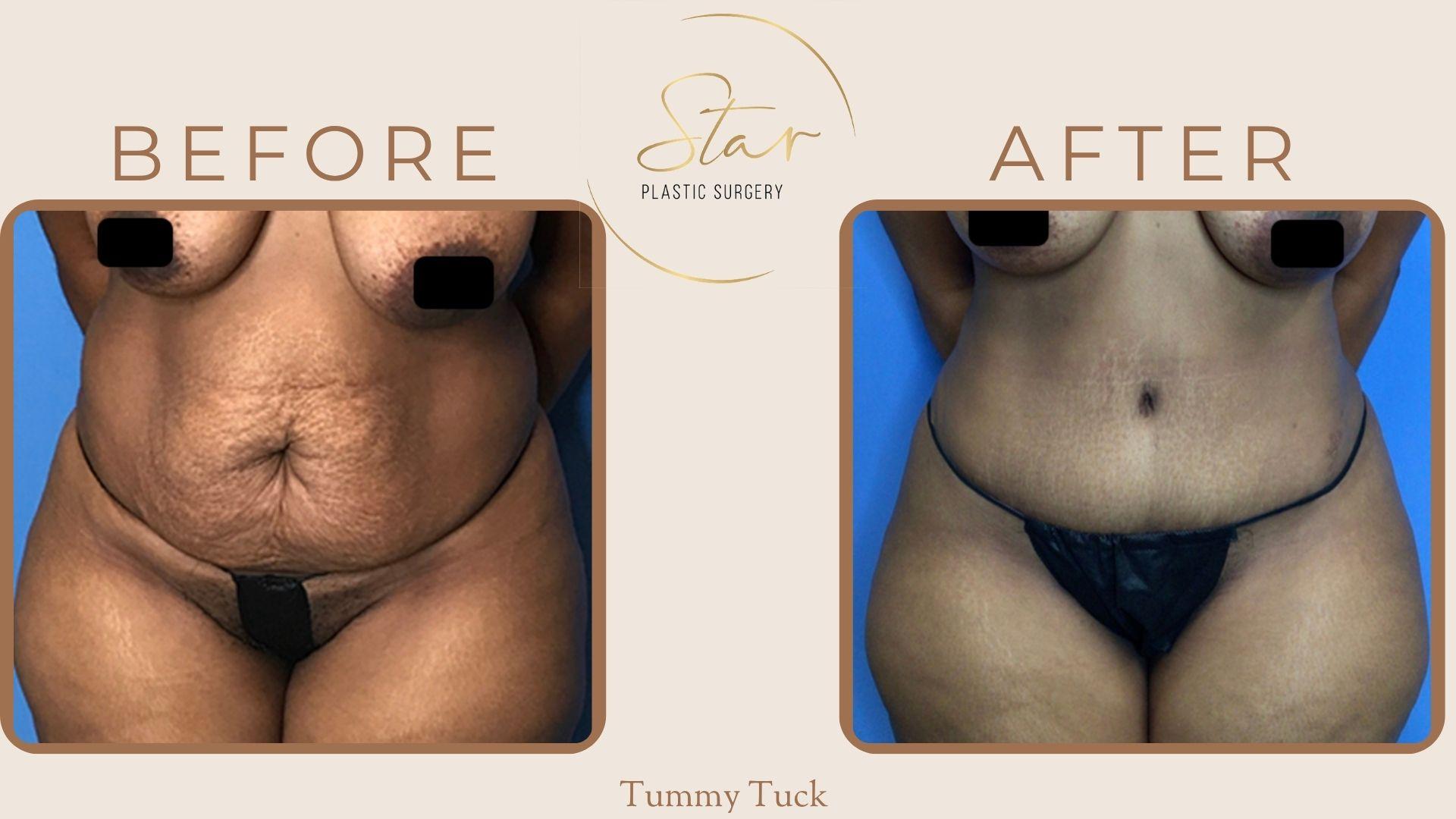 Star Plastic Surgery tummy tuck result — Novi, MI