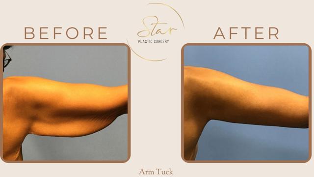 Arm Lift result at Star Plastic Surgery in Novi, MI
