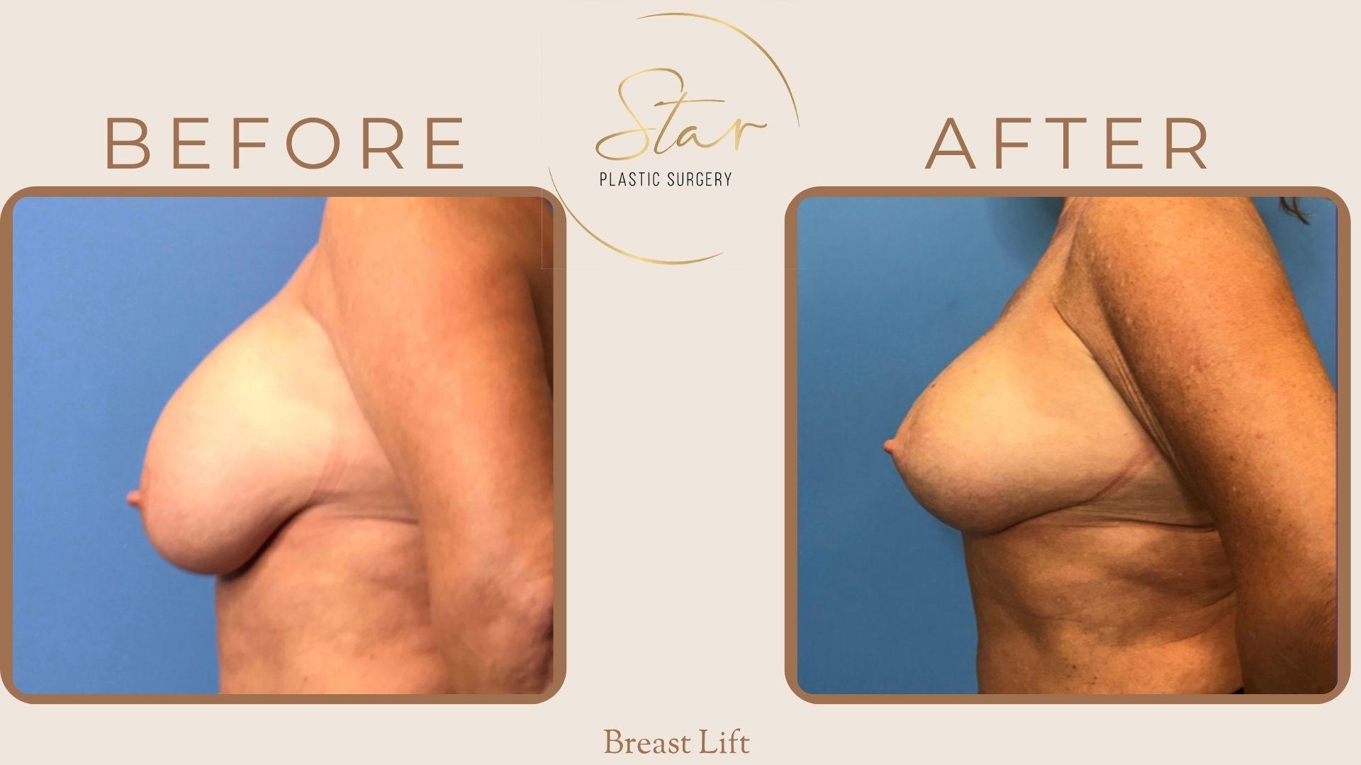 Star Plastic Surgery breast lift result — Novi, MI
