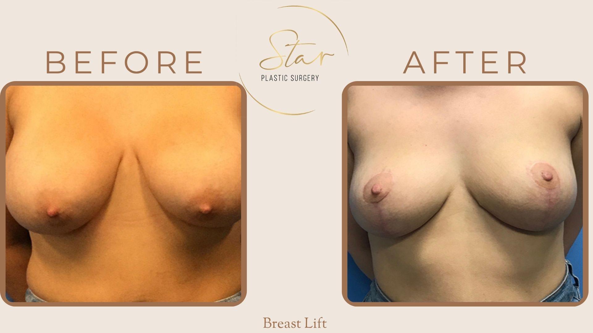 Star Plastic Surgery breast lift result — Novi, MI