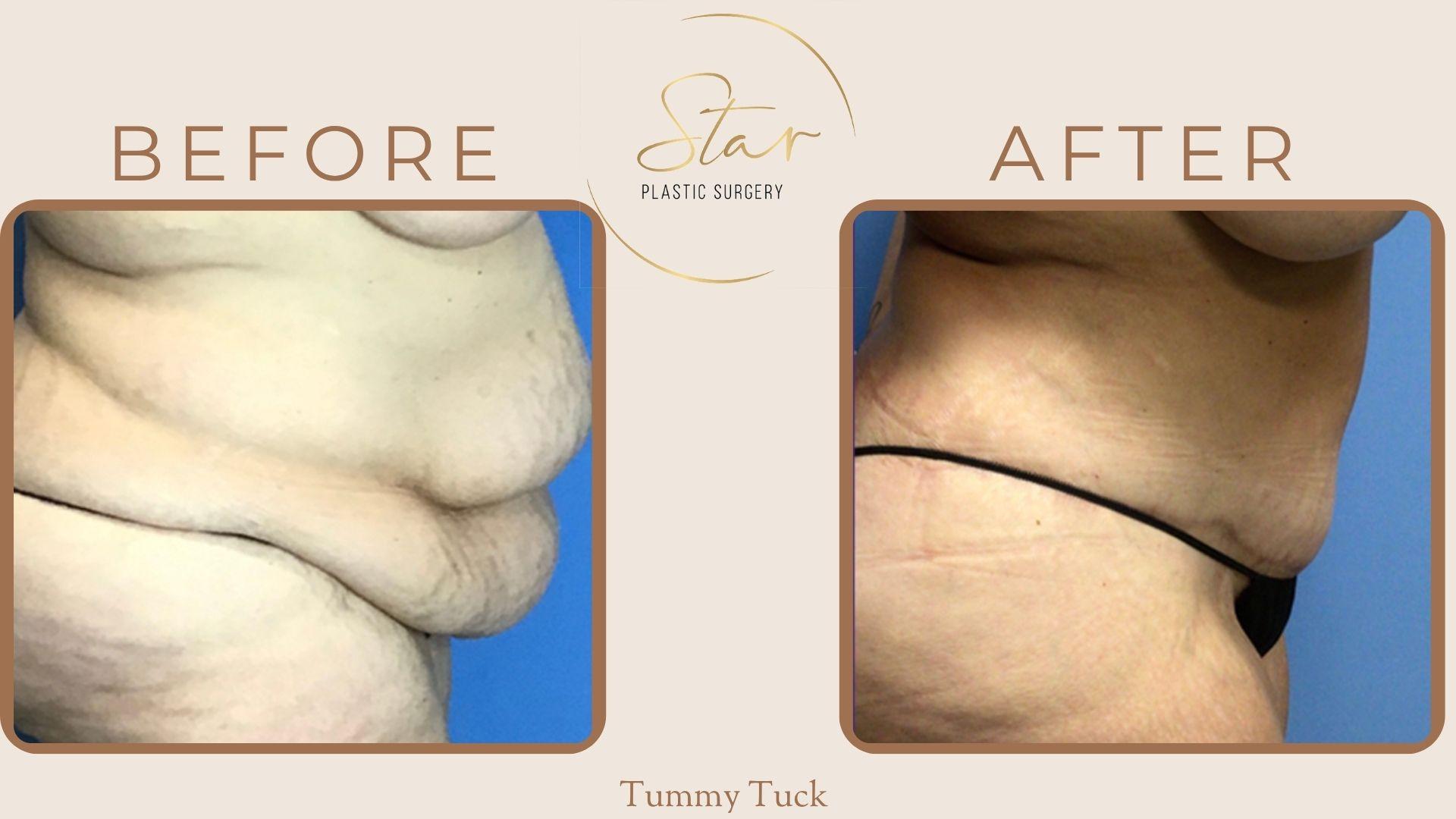 Star Plastic Surgery tummy tuck result — Novi, MI
