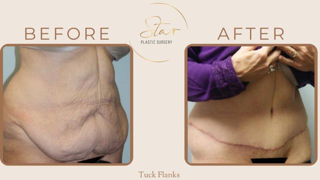 Thigh Lift result at Star Plastic Surgery in Novi, MI