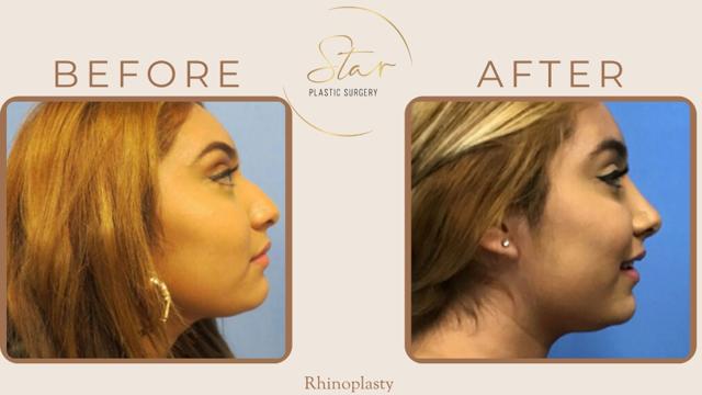 Rhinoplasty result at Star Plastic Surgery in Novi, MI