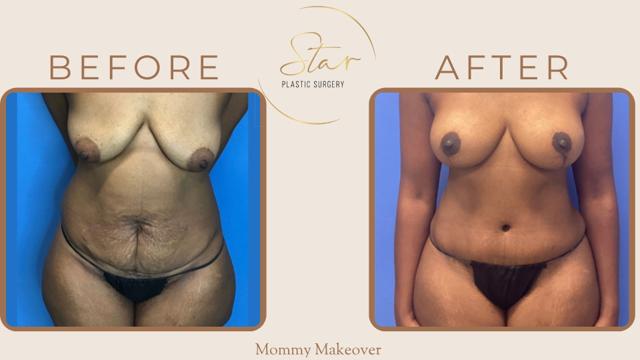Mommy Makeover result at Star Plastic Surgery in Novi, MI