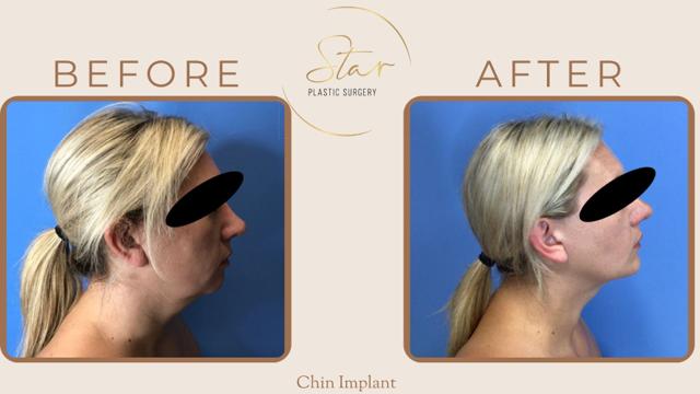 Chin Implant result at Star Plastic Surgery in Novi, MI