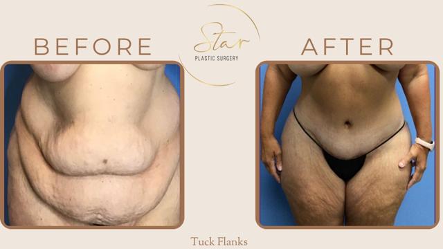 Thigh Lift result at Star Plastic Surgery in Novi, MI