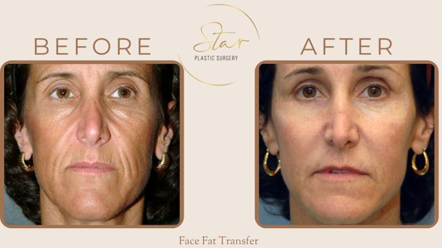 Fat Transfer result at Star Plastic Surgery in Novi, MI