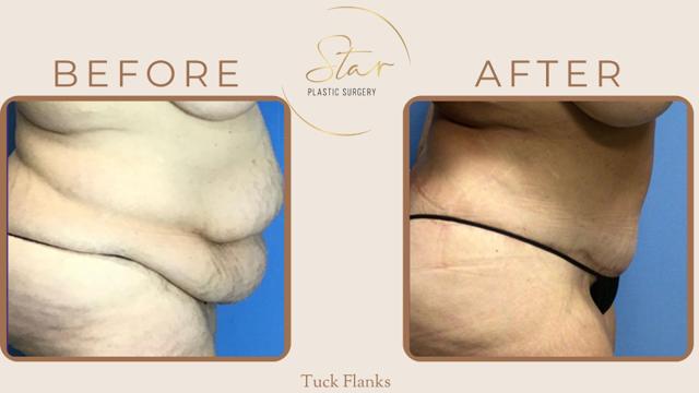 Thigh Lift result at Star Plastic Surgery in Novi, MI