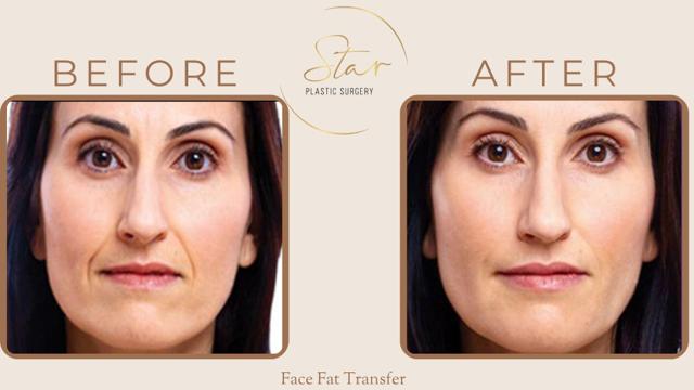 Fat Transfer result at Star Plastic Surgery in Novi, MI