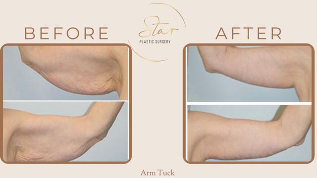 Arm Lift result at Star Plastic Surgery in Novi, MI