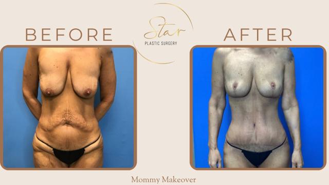 Mommy Makeover result at Star Plastic Surgery in Novi, MI