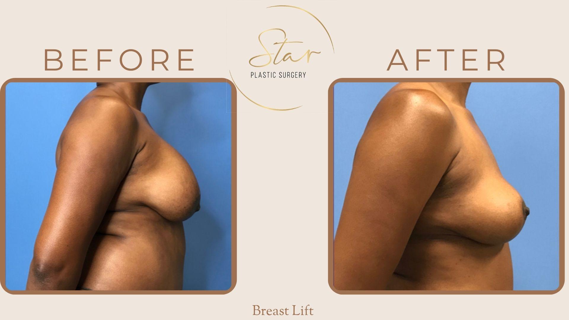 Star Plastic Surgery breast lift result — Novi, MI