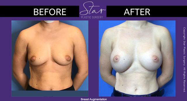 Breast Augmentation result at Star Plastic Surgery in Novi, MI