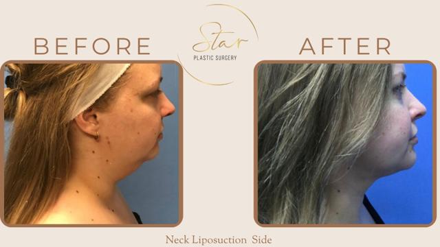 Liposuction result at Star Plastic Surgery in Novi, MI