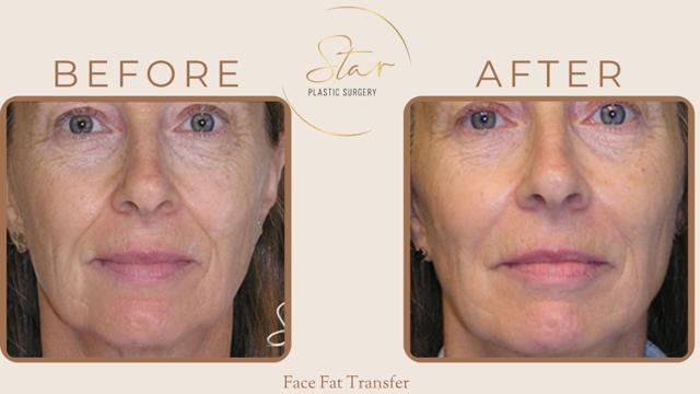 Fat Transfer result at Star Plastic Surgery in Novi, MI