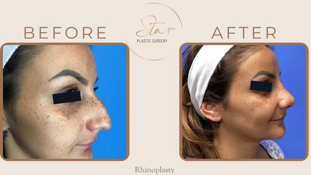 Rhinoplasty result at Star Plastic Surgery in Novi, MI