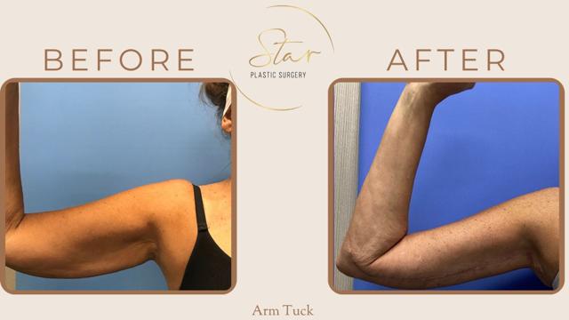 Arm Lift result at Star Plastic Surgery in Novi, MI