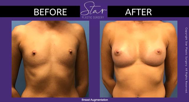 Breast Augmentation result at Star Plastic Surgery in Novi, MI
