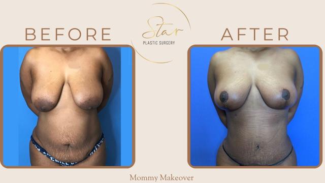Mommy Makeover result at Star Plastic Surgery in Novi, MI