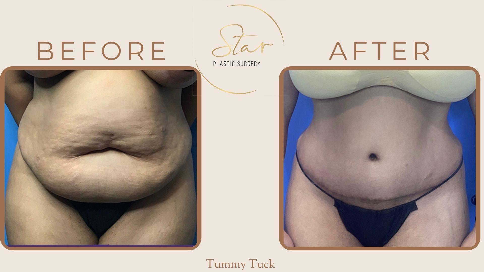 Star Plastic Surgery tummy tuck result — Novi, MI