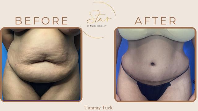 Mini Tummy Tuck result at Star Plastic Surgery in Novi, MI