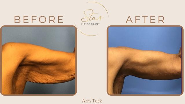 Arm Lift result at Star Plastic Surgery in Novi, MI