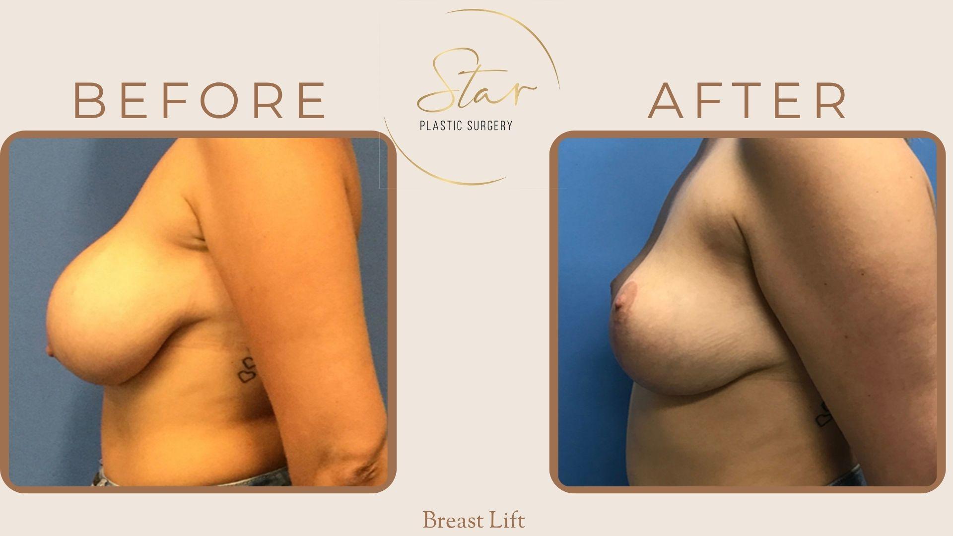Star Plastic Surgery breast lift result — Novi, MI
