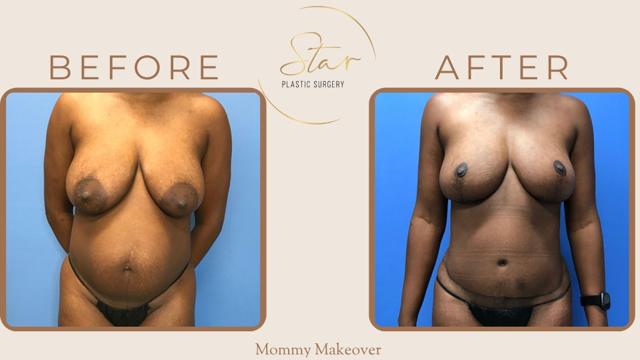 Mommy Makeover result at Star Plastic Surgery in Novi, MI