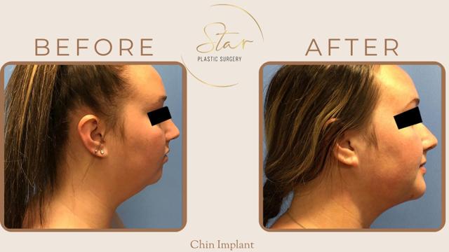 Chin Implant result at Star Plastic Surgery in Novi, MI
