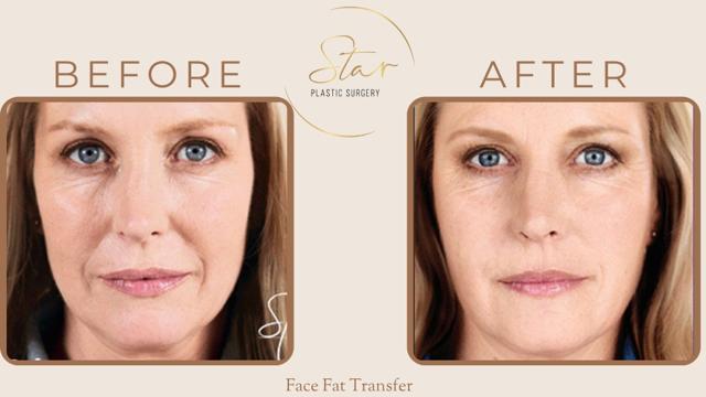 Fat Transfer result at Star Plastic Surgery in Novi, MI
