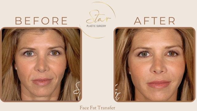 Fat Transfer result at Star Plastic Surgery in Novi, MI