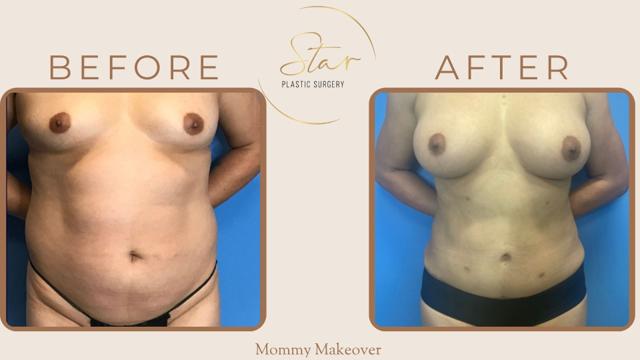 Mommy Makeover result at Star Plastic Surgery in Novi, MI