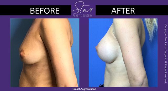 Breast Augmentation result at Star Plastic Surgery in Novi, MI
